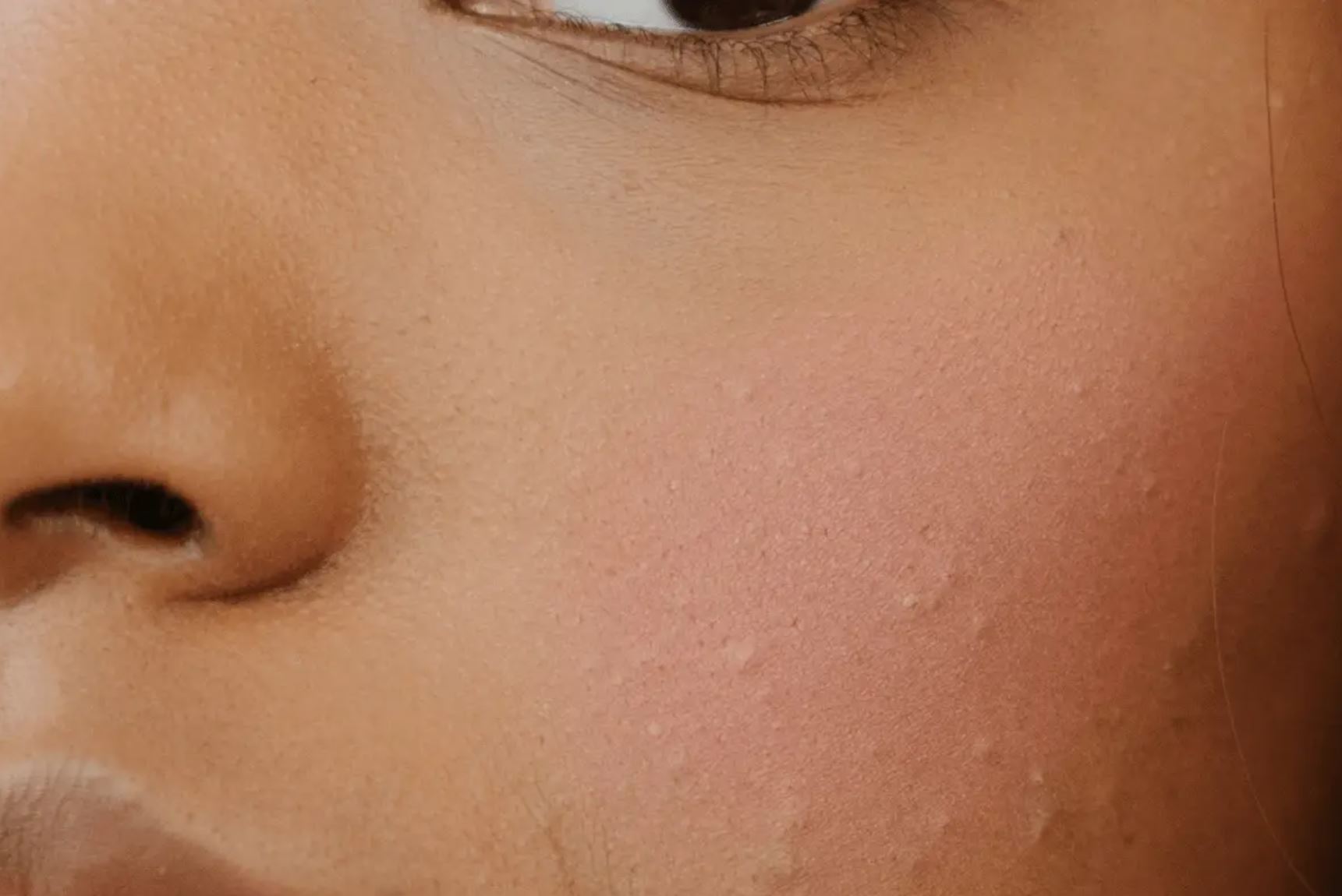 10 conseils pour en finir avec les boutons d'acné sur la peau noire